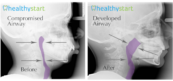 Compromised airway before and after sleep disordered breathing treatment