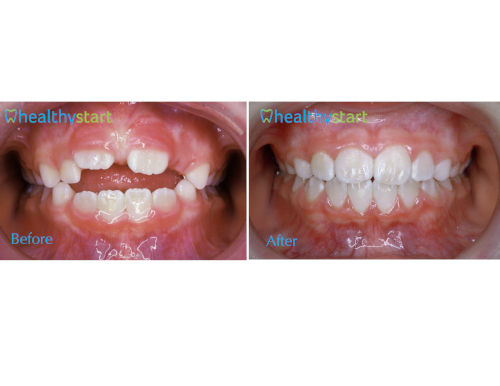 Open bite before and after treatment with the HealthyStart system