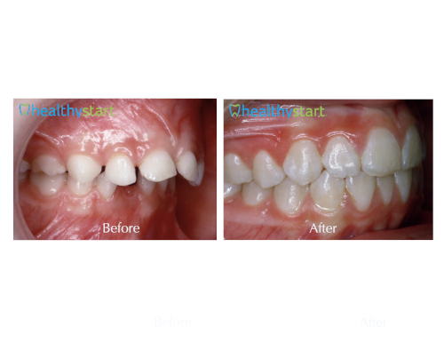 Underdeveloped jaw treated with HealthyStart